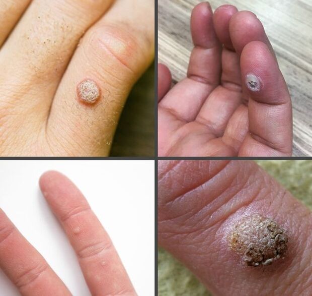 手指上常见的疣类型