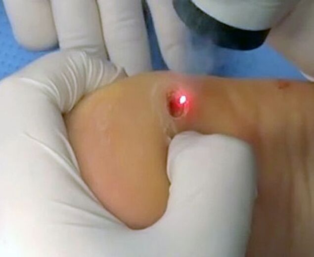 用激光去除脚后跟疣的手术。
