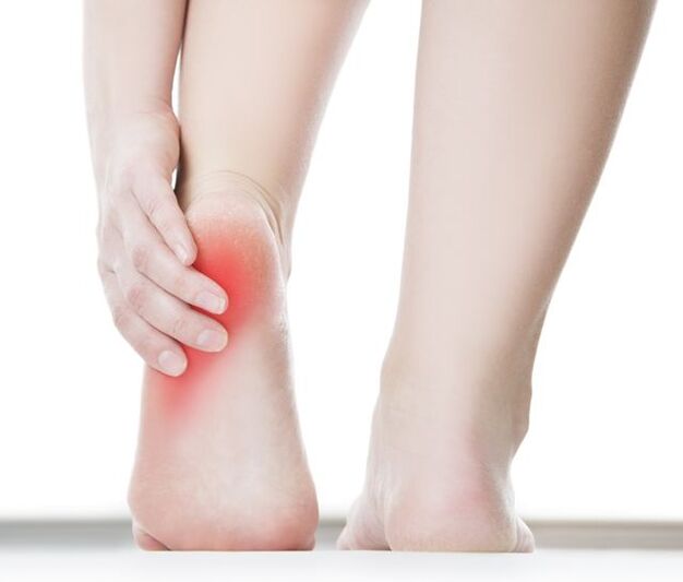 脚后跟上的疣会引起剧烈疼痛。
