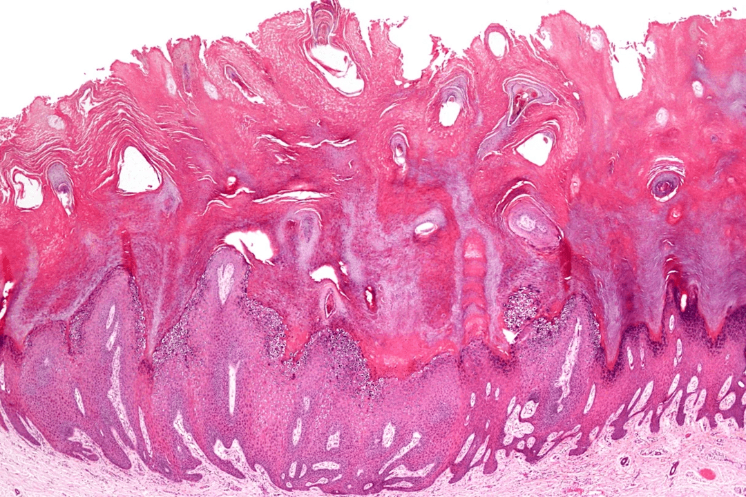 乳头状瘤发展阶段